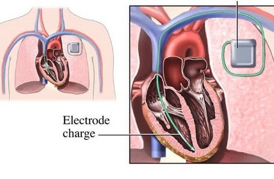 Automatic Implantable Cardiocerter Defibrillator Aicd Surgery In India Cost Hospitals 8508